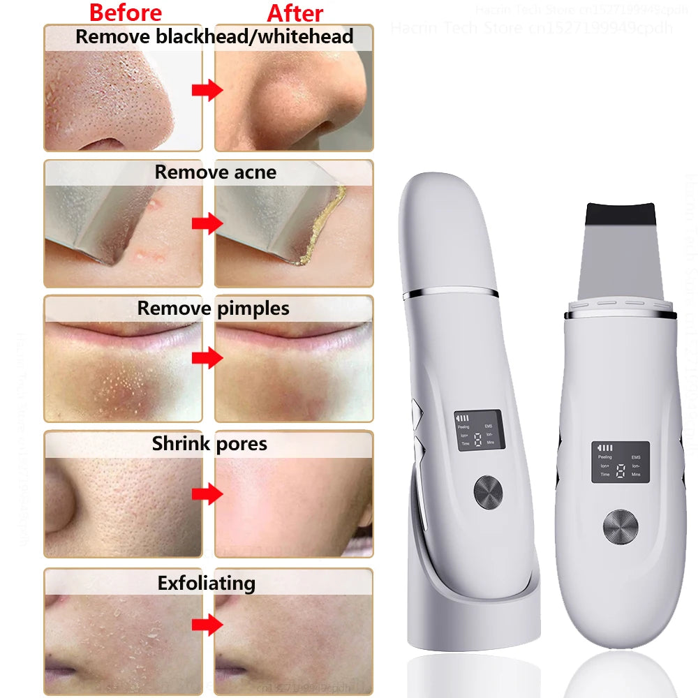 Pure Complexion™ Ultrasonic Skin Scrubber