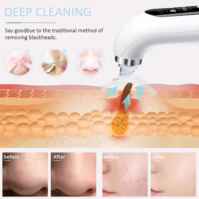 Small Bubble Facial Cleasing Machine